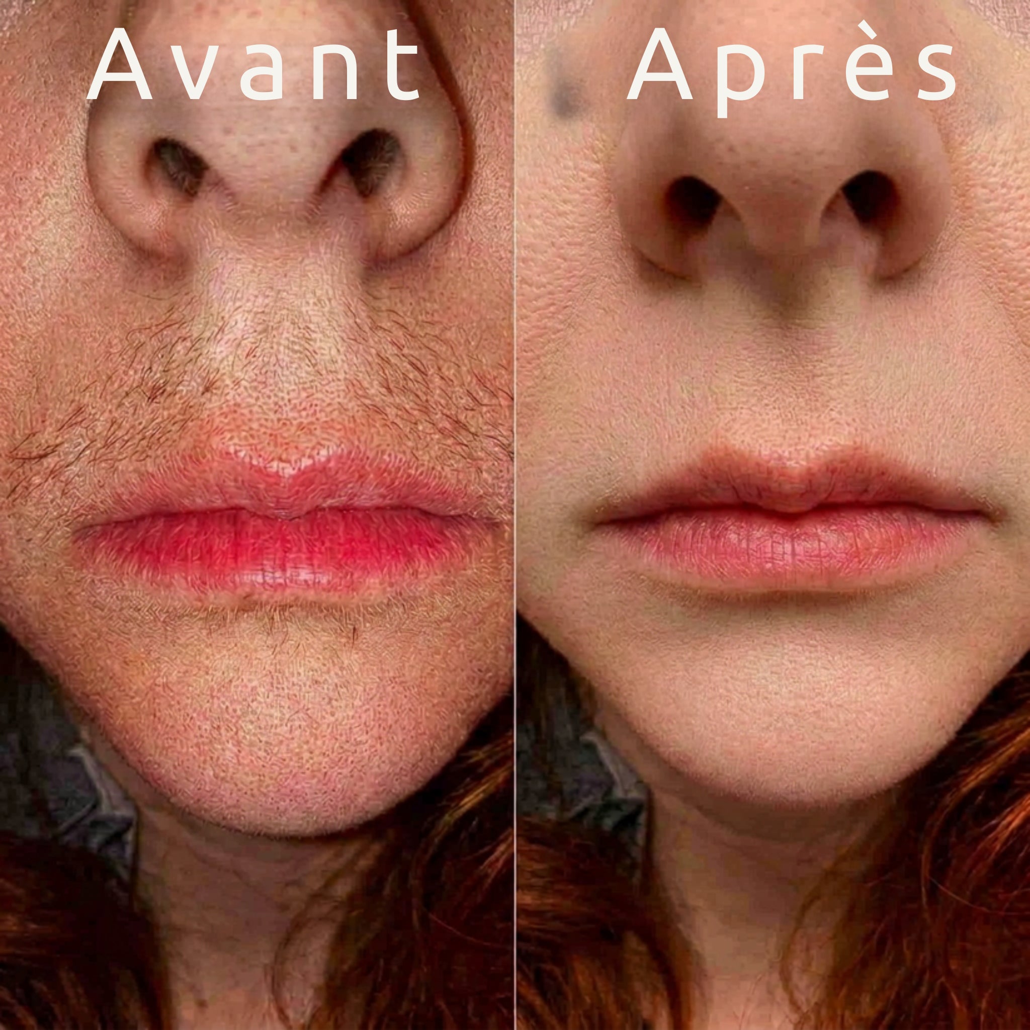 Le soin anti-repousse naturel — Nala™