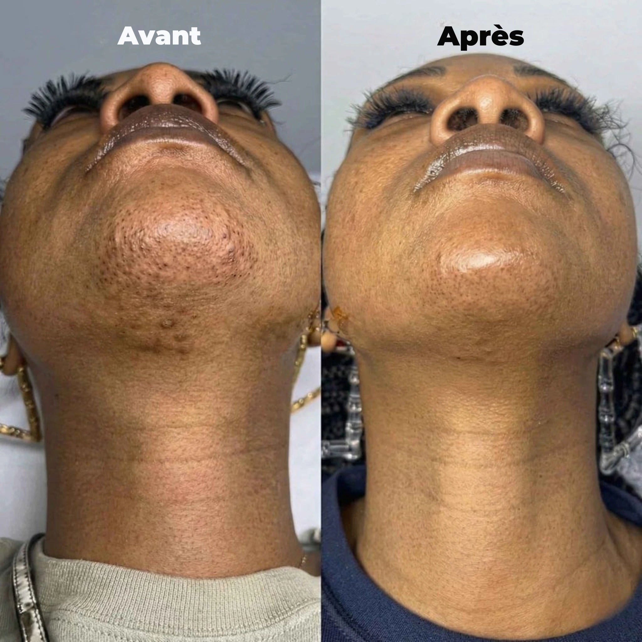 Le soin anti-repousse naturel — Nala™
